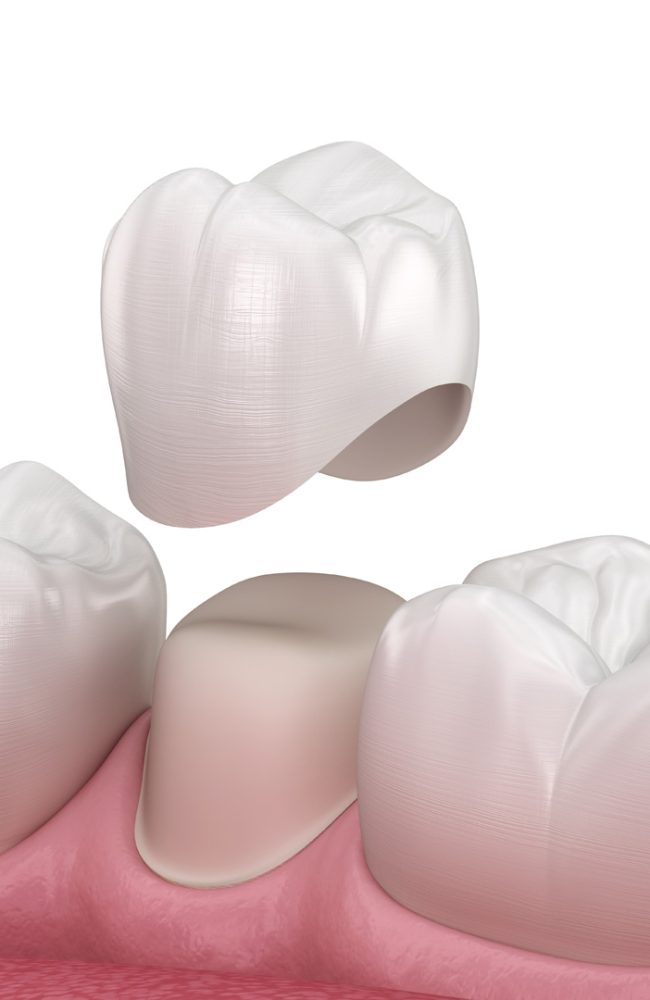 Preparated premolar tooth and dental crown placement. Medically accurate 3D illustration