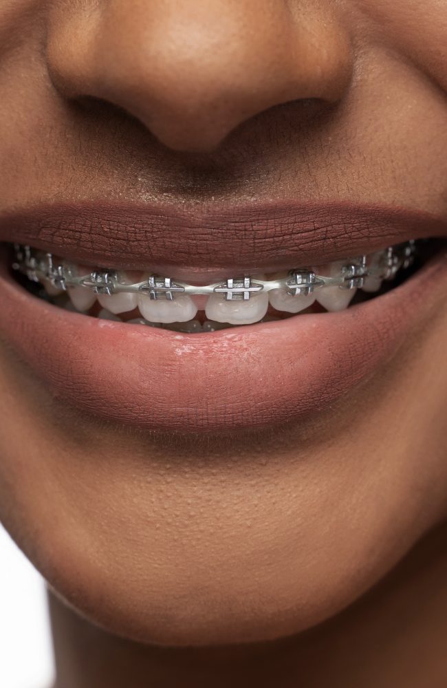 Closeup of black woman's smile with a dental braces on teeth